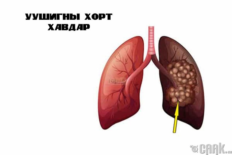 Уушгины хорт хавдар