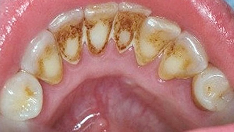 Эмчид очилгүйгээр шүдний шарыг хэрхэн арилгах вэ?