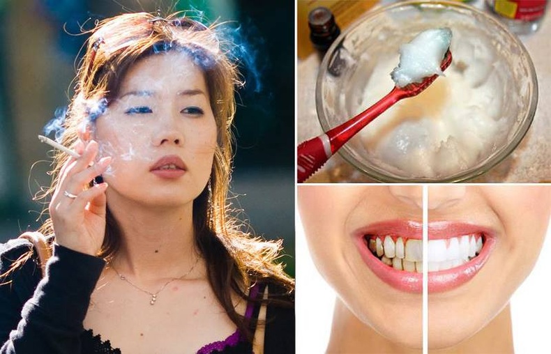 Тамхинаас үүдэлтэй шүдний шарыг хэрхэн арилгах вэ?