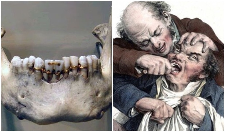 "Аймшигт эмчилгээ" - Эрт үеийн шүдний эмч нарын хэрэглэдэг байсан аргууд