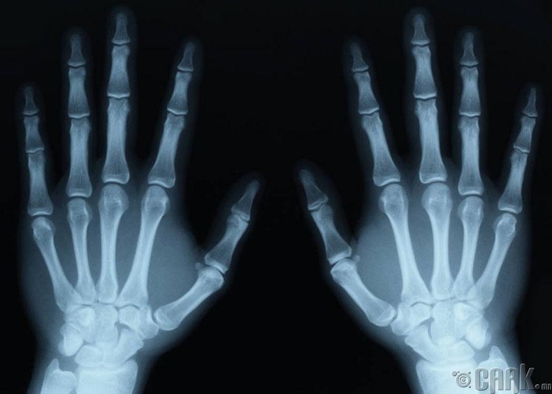 Рентген болон томографи зураг