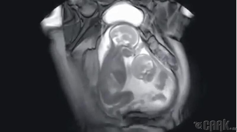 Эхийн хэвлий дэх 2 ихэр ураг- MRI шинжилгээ