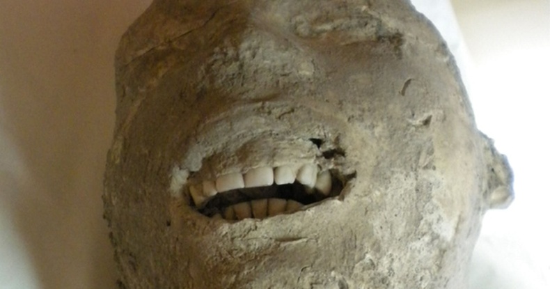 2000 жилийн өмнө Помпей хотыг сүйрүүлсэн Везувий галт уулын дэлбэрэлтэд үрэгдсэн хүний шүд нь бараг хэвээрээ үлджээ