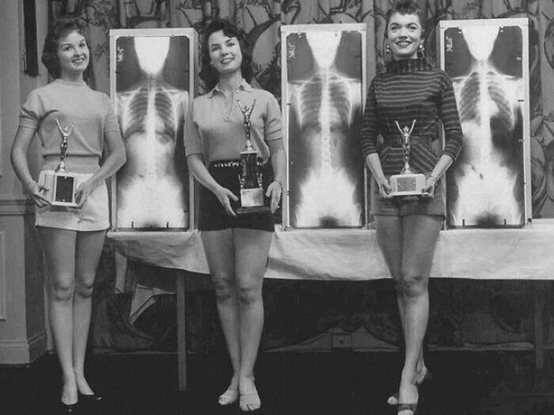 1956 оны Чикаго хотод болсон гоо бүсгүйн тэмцээний болзлын дагуу оролцогчид өөрсдийн тэгшхэн нурууг харуулсан рентген зургийг толилуулж байв.