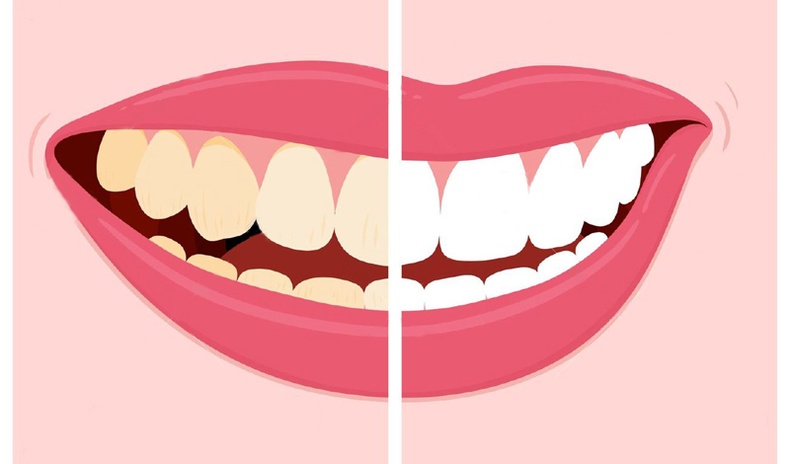 Шүд юунаас болж шарладаг вэ?