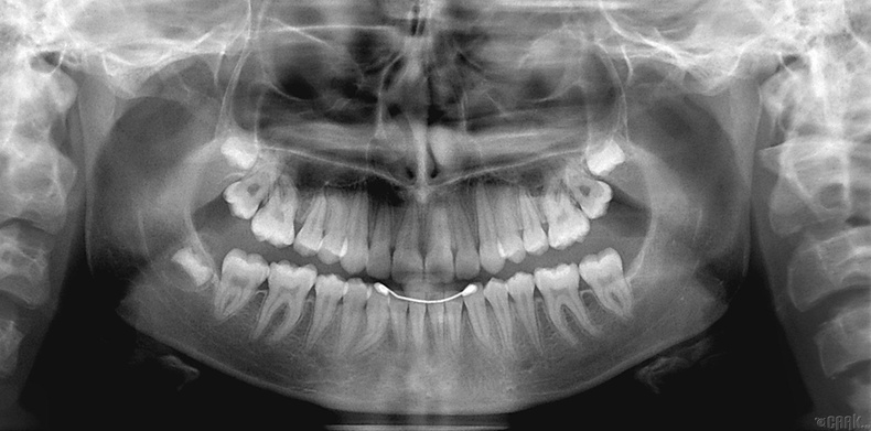 Испанийн архелогичид аарцгандаа шүдтэй эмэгтэйн цогцос олжээ