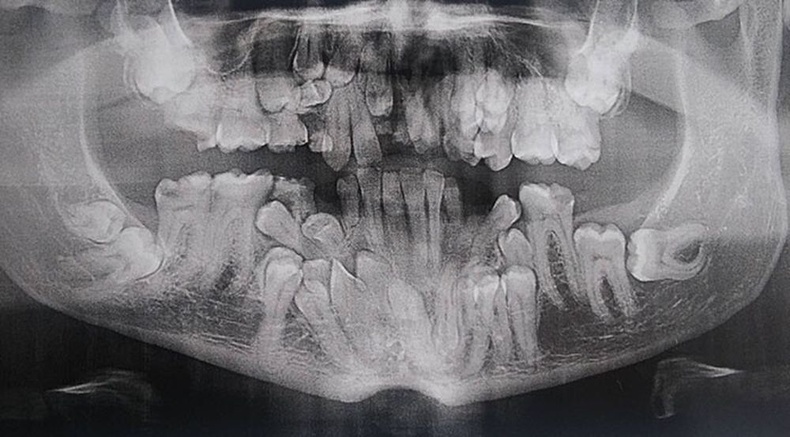 Cleidocranial dysostosis оноштой хүний шүд