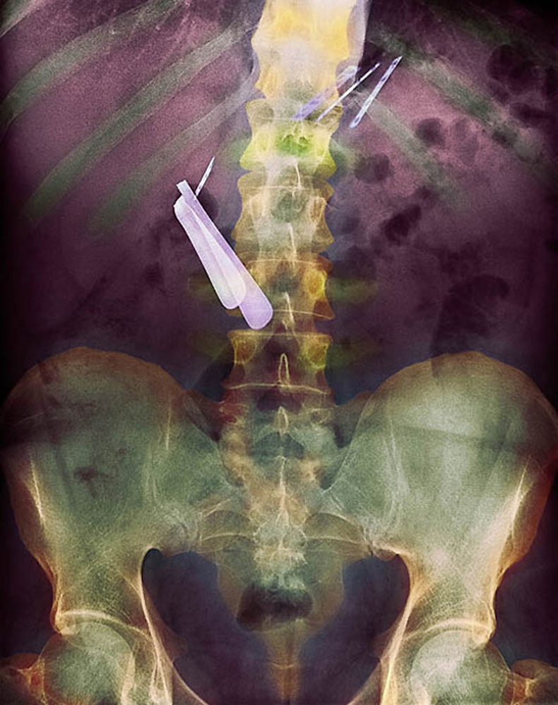 Сахлын хутга (зүүн голд) ба бритва (баруун дээд талд) залгисан өвчтөний ходоодны өнгөт рентген зураг