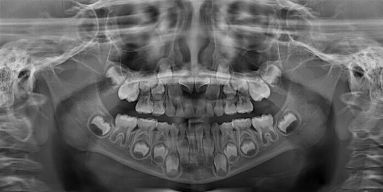 6-12 насны хүүхдийн шүдний рентген