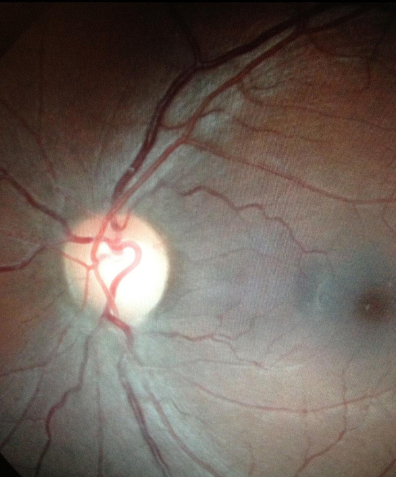 Зүрх хэлбэртэй нүдний судас