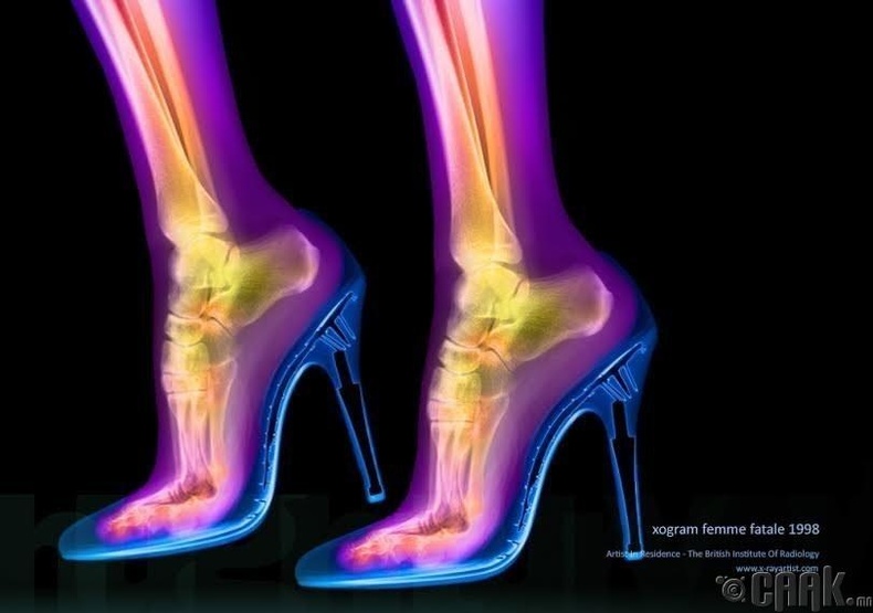 Өндөр өсгийт эмэгтэй хүний хөлийг ингэж өөрчилдөг. (Турвейгийн эхнэрийн хөл)