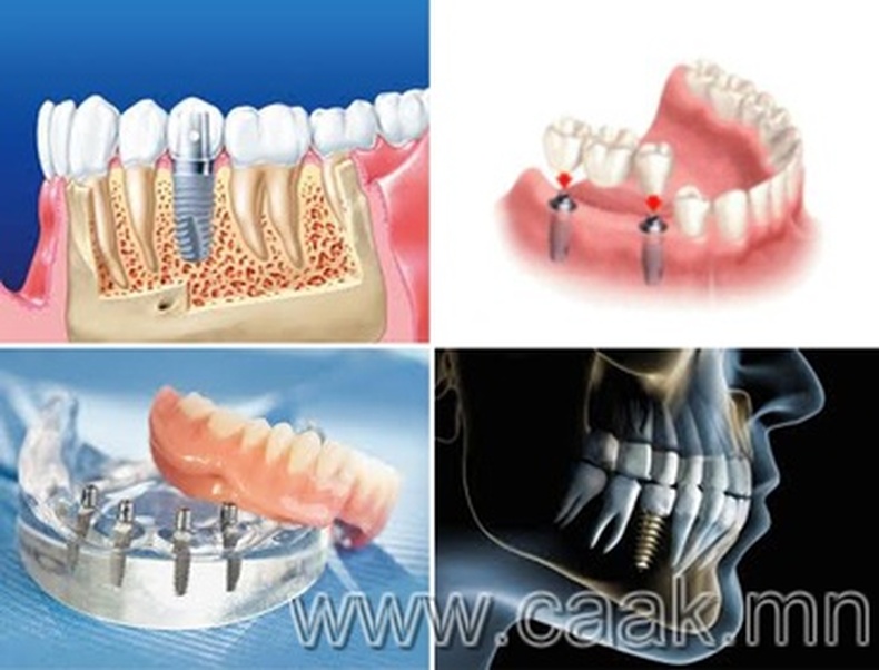 Хатагтай ДЕНТ шүднийэмнэлэгт суулгаж буй шүдний имплантын давуу тал